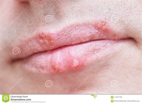 Herpes Simplex Virus Infection On Male Face Lips Stock ...