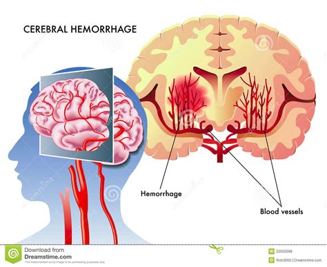 Hersen bloeding vector illustratie. Illustratie bestaande ...