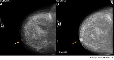 Hidroadenocarcinoma de células claras de localización mamaria | Cirugía ...
