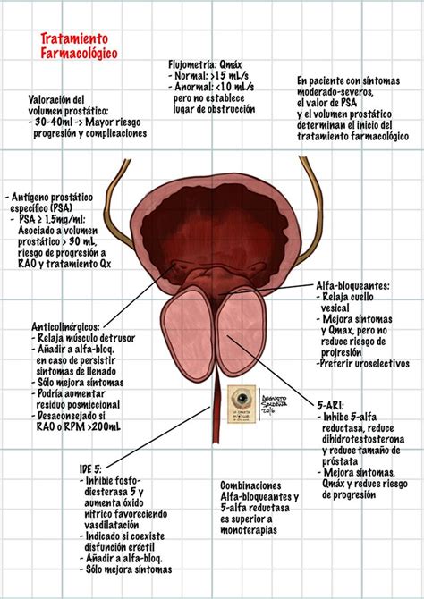 Hiperplasia benigna de próstata  AMF 2016  Más que 1.000 palabras ...