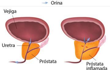 Hiperplasia benigna de próstata Causas, síntomas y tratamiento