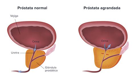 Hiperplasia benigna de próstata | Clínicas García Reboll