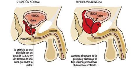 Hiperplasia benigna de próstata   DR. ARIEL ISSA