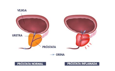 Hiperplasia benigna de próstata  HBP  y prostatitis ...
