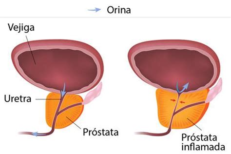 Hiperplasia benigna de próstata, qué es y causas   Salud ...