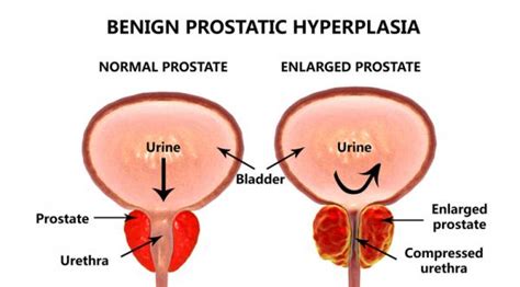 Hiperplasia benigna de próstata: síntomas, grados y ...
