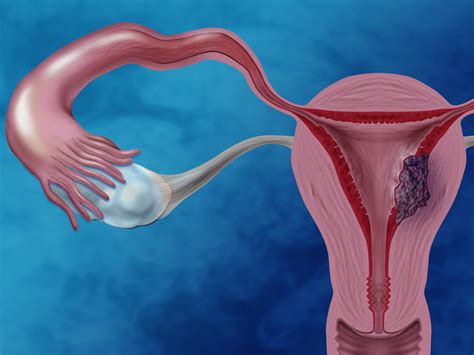 HIPERPLASIA DE ENDOMETRIO   Noticias inmater