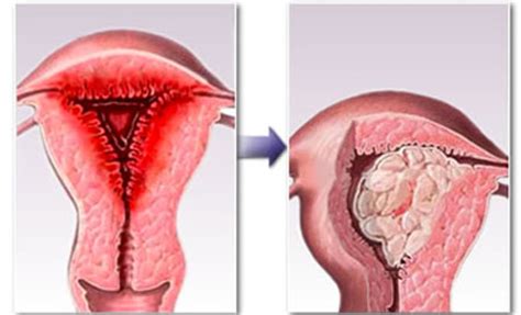 Hiperplasia del endometrio, ¿qué es?   Especies, síntomas y tratamiento