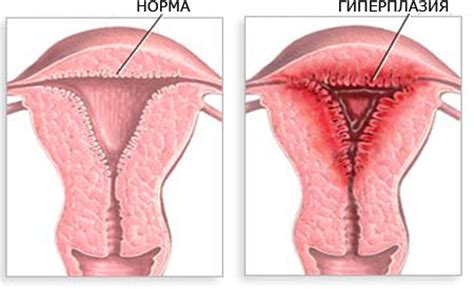 Hiperplasia del endometrio, ¿qué es?   Especies, síntomas y tratamiento