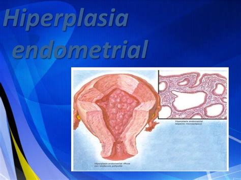 Hiperplasia endometrial  2