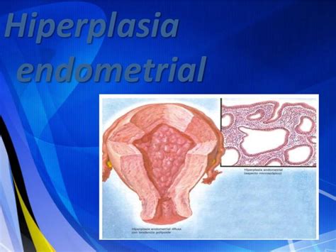 Hiperplasia endometrial  2