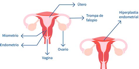 Hiperplasia endometrial: Causas, Síntomas y Tratamiento
