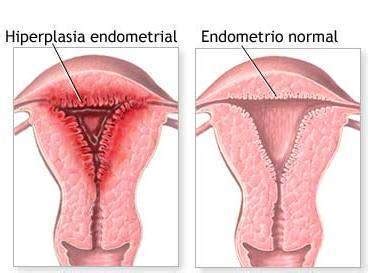 Hiperplasia endometrial compleja   EcuRed