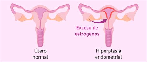 hiperplasia endometrial, crecimiento endometrial, hiperplasia endometrio