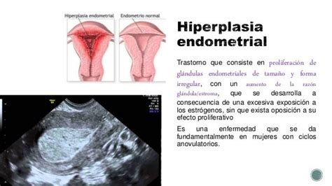 Hiperplasia endometrial