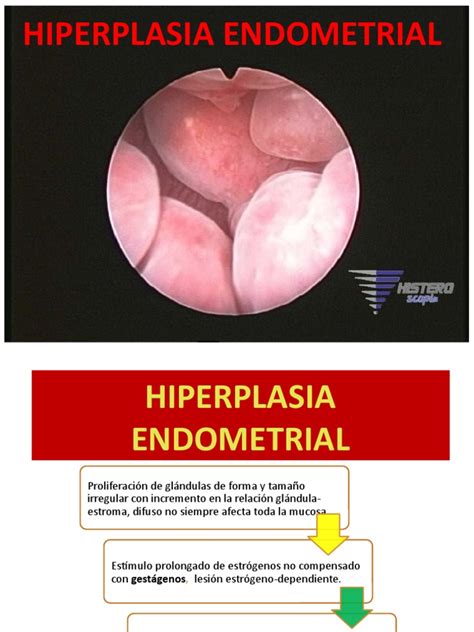 Hiperplasia Endometrial | PDF | La salud de la mujer | Medicina