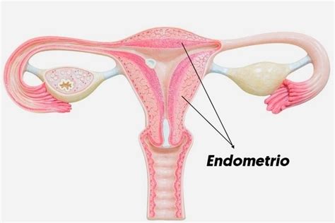 Hiperplasia Endometrial: qué es, síntomas y tratamiento   Tua Saúde