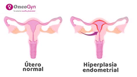 Hiperplasia Endometrial   Síntomas y detección | OncoGyn