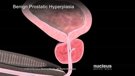 Hiperplasia Prostatica Benigna Fisiopatologia   slingo
