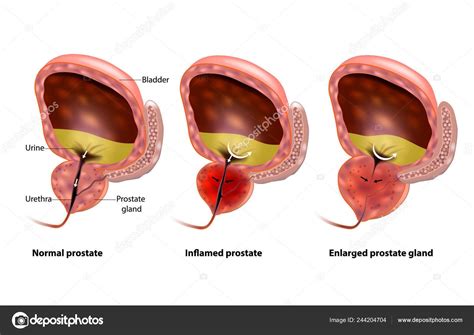 Hiperplasia prostática benigna  HPB . Inflamación de ...