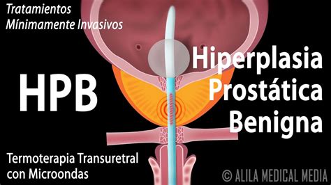 Hiperplasia Prostática Benigna, HPB, y Tratamientos. Alila Medical ...