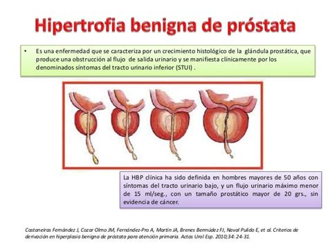 Hipertrofia benigna de próstata USP