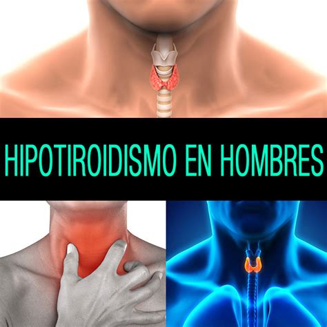 Hipotiroidismo En Hombres: Síntomas, Causas Y Tratamiento ...