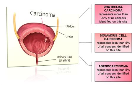 Histological types of bladder cancer. | Download ...
