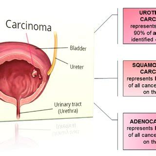Histological types of bladder cancer. | Download ...