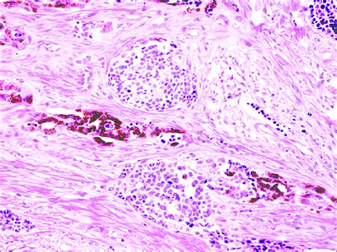Histopathological picture pigmented teratoma, atypical melanoblastoma ...