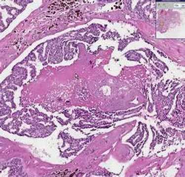 Histopathology Breast  Ductal carcinoma in situ   YouTube