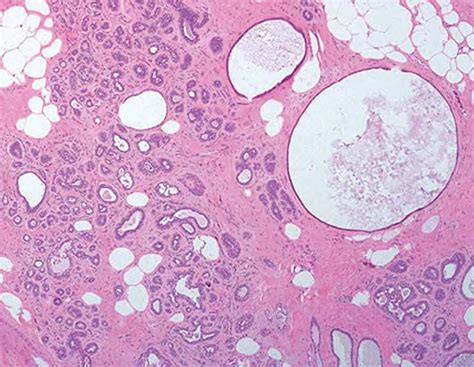 Histopatología: PATOLOGIA MAMARIA