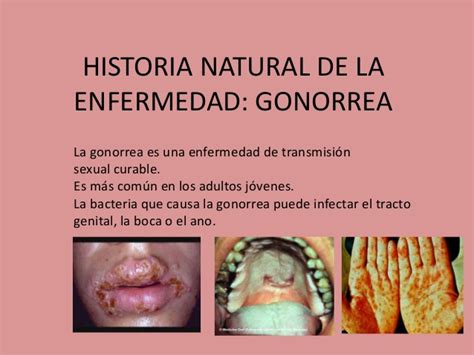 Historia natural de la enfermedad gonorrea