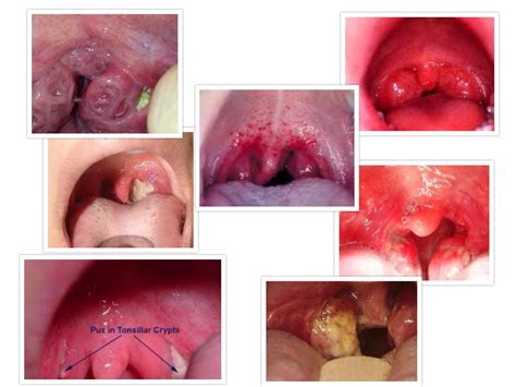 Holes/Crypts in Tonsils and Strep Throat   Pictures and ...