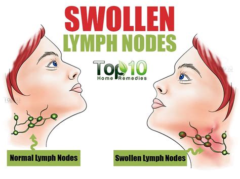 Home Remedies for Swollen Lymph Nodes | Top 10 Home Remedies