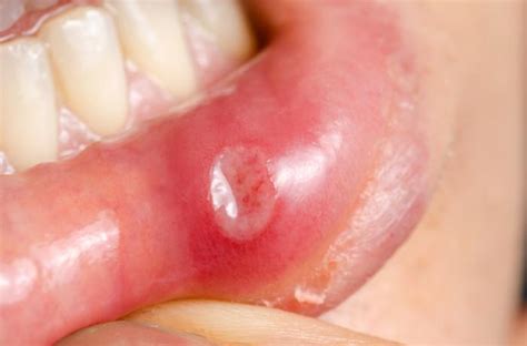 Home Remedies that help getting rid of Canker Sores