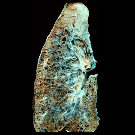 Honeycomb lung: gross pathology | Image | Radiopaedia.org