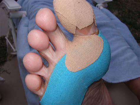 Hotspots And Blisters: Foot Care Tips For The Trail ...