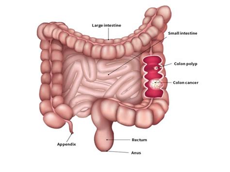 How Common is Colorectal Cancer, Rectal Cancer ...