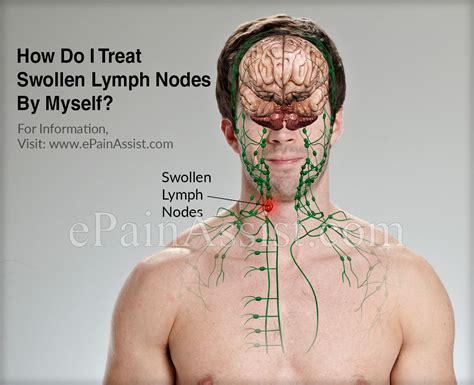 How Do I Treat Swollen Lymph Nodes By Myself?