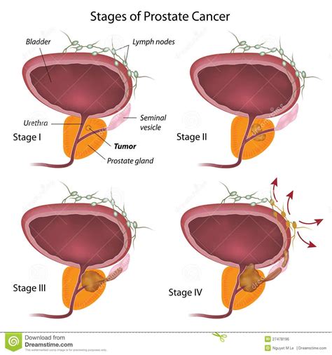 How Does Prostate Cancer Develop   Brittany Roy s Blog