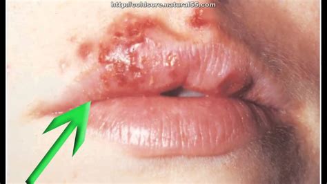 How To Cure Cold Sores On Lips Fast | Natural Treatment ...