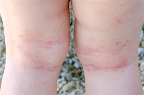 How to Identify Eczema in Children