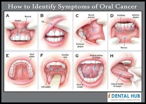 How to identify signs and symptoms of oral cancer and its ...