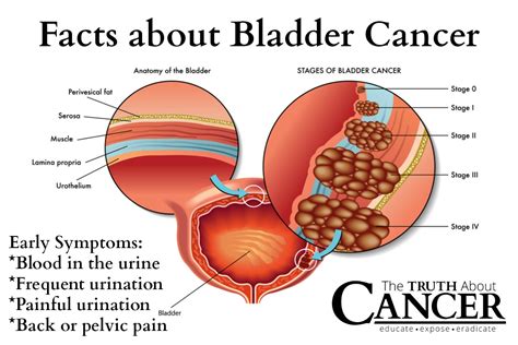 How To Know If Bladder Cancer Is Hitting You?