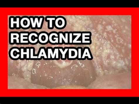 How to Recognize Chlamydia in Women and Treatment   YouTube