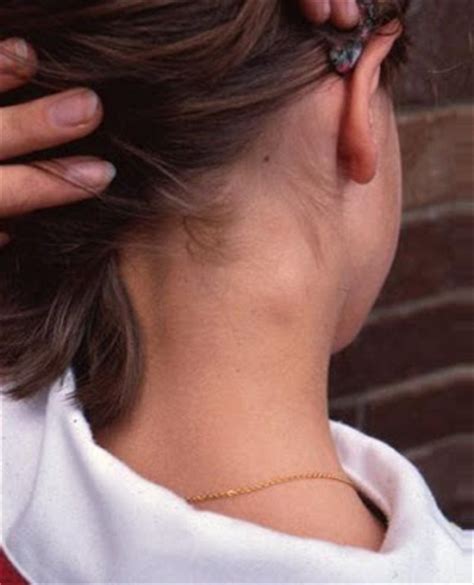 How to reduce swollen lymph nodes in neck?