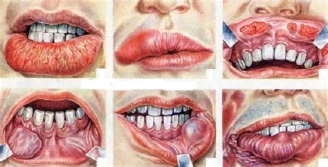 How To Spot Oral Cancer And Ways To Cope With It ...