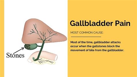 How to Stop Your Gallbladder Pain in 15 Minutes  Naturally!