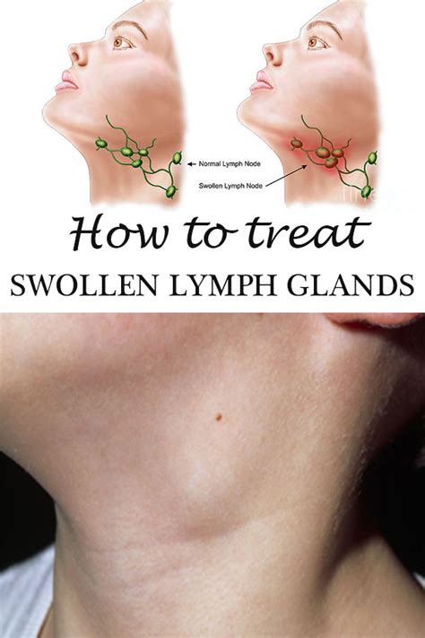 How to treat swollen lymph glands   Everything in one place